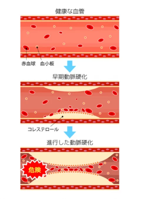 動脈硬化進行の流れ