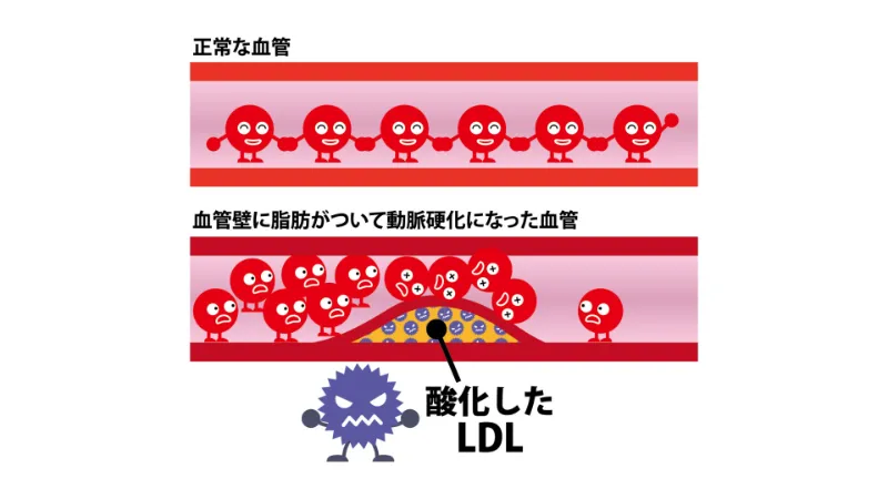 血管内でLDLコレステロールが酸化した状態